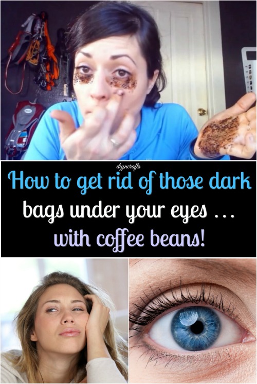How to Get Rid of Dark Bags