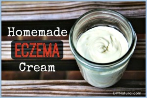 How to Make Homemade Natural Eczema Cream